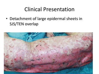 Clinical Presentation
• Detachment of large epidermal sheets in
SJS/TEN overlap
 