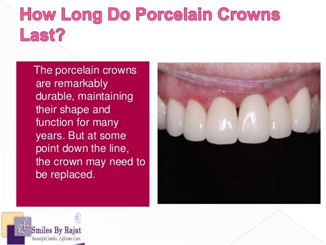 Average Lifespan of Dental Crowns