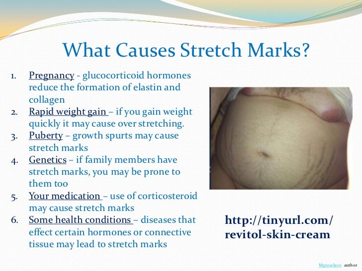 what is the best cream for stretch marks how do stretch marks form