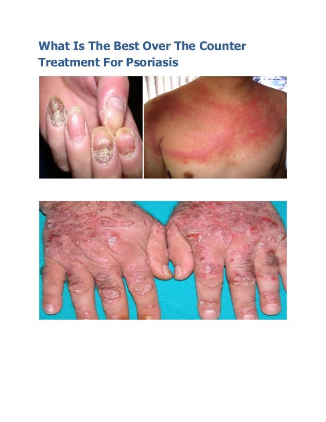 What is the best over the counter treatment for psoriasis
