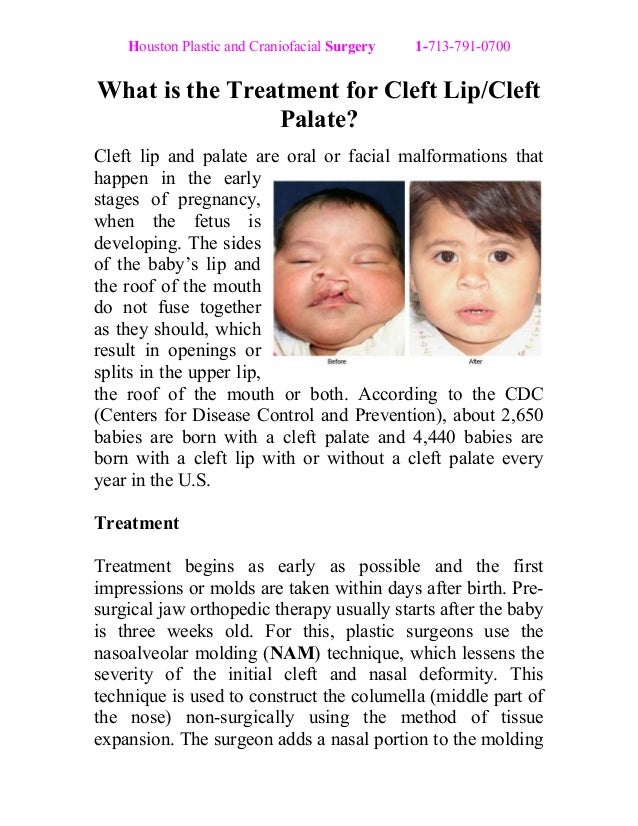 What is the Treatment for Cleft Lip/Cleft Palate?