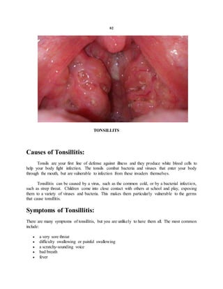 02
TONSILLITS
Causes of Tonsillitis:
Tonsils are your first line of defense against illness and they produce white blood cells to
help your body fight infection. The tonsils combat bacteria and viruses that enter your body
through the mouth, but are vulnerable to infection from these invaders themselves.
Tonsillitis can be caused by a virus, such as the common cold, or by a bacterial infection,
such as strep throat. Children come into close contact with others at school and play, exposing
them to a variety of viruses and bacteria. This makes them particularly vulnerable to the germs
that cause tonsillitis.
Symptoms of Tonsillitis:
There are many symptoms of tonsillitis, but you are unlikely to have them all. The most common
include:
 a very sore throat
 difficulty swallowing or painful swallowing
 a scratchy-sounding voice
 bad breath
 fever
 