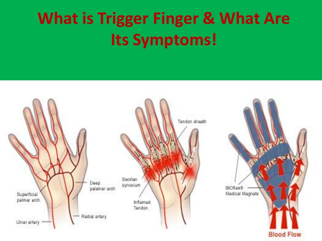What is trigger finger & what are its symptoms!