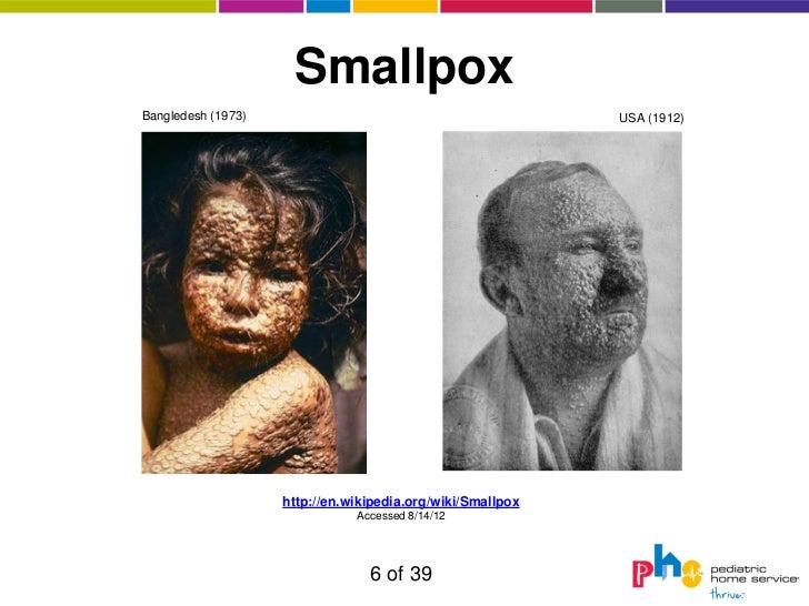 bubonic plague vs smallpox essay Treatment of bubonic or septicaemic plague and is the drug of choice for treatment of patients with y pestis invasion of tissue spaces into which. bubonic plague vs smallpox essay Treatment of bubonic or septicaemic plague and is the drug of choice for treatment of patients with y pestis invasion of tissue spaces into which.