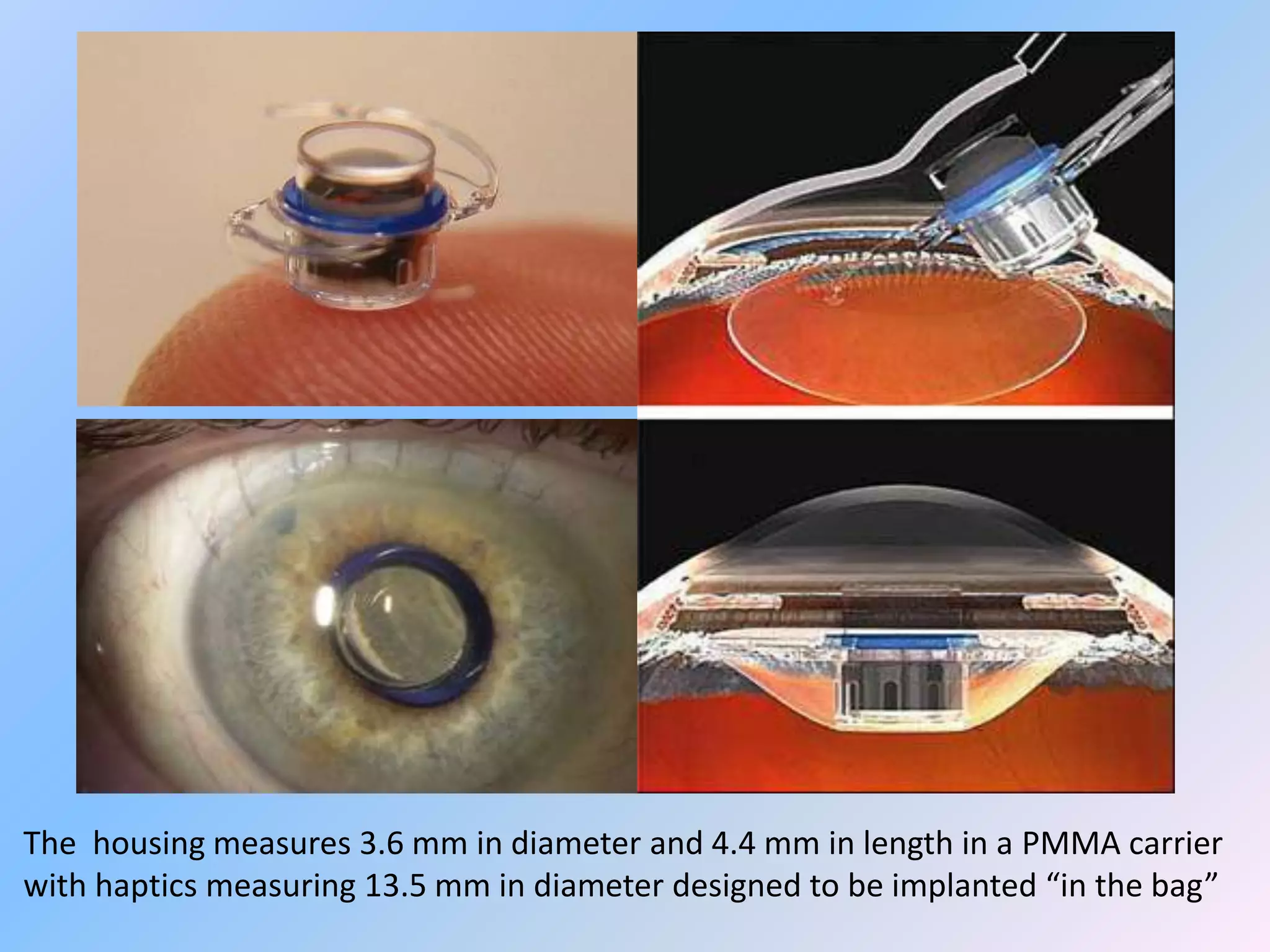The housing measures 3.6 mm in diameter and 4.4 mm in length in a PMMA carrier
with haptics measuring 13.5 mm in diameter designed to be implanted “in the bag”
 