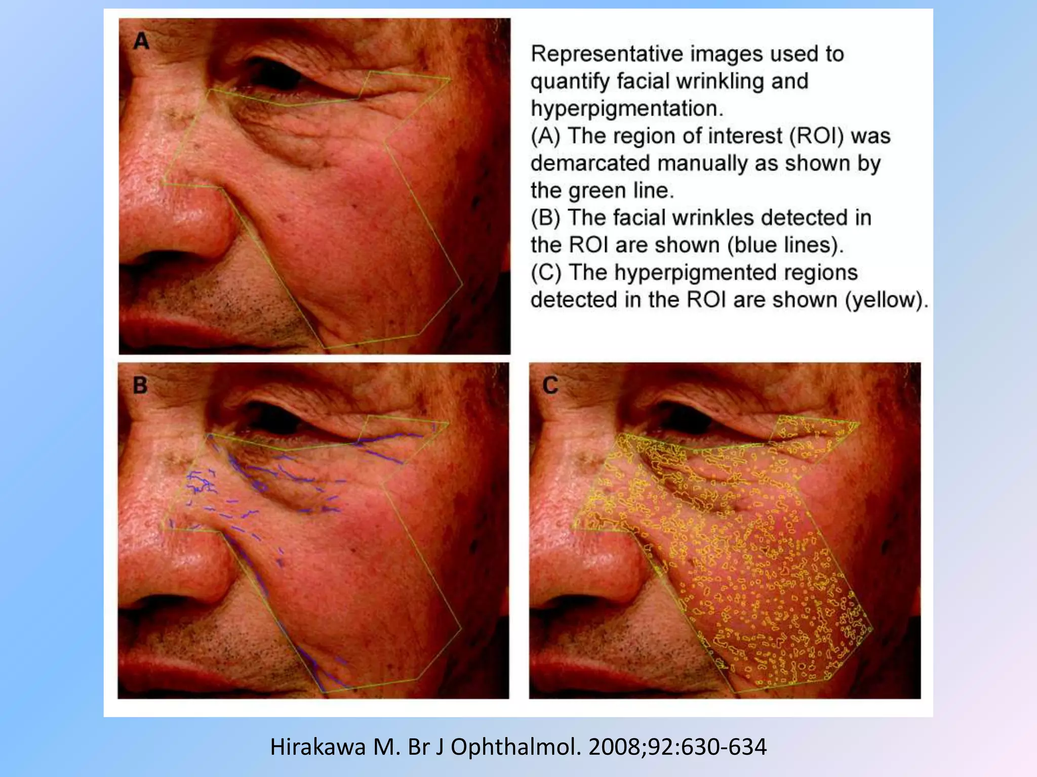Hirakawa M. Br J Ophthalmol. 2008;92:630-634
 
