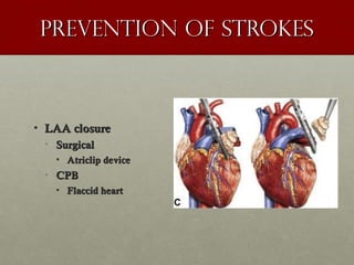 Prevention of strokesPrevention of strokes
• LAA closureLAA closure
• SurgicalSurgical
• Atriclip deviceAtriclip device
• CPBCPB
• Flaccid heartFlaccid heart
 