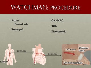 Watchman:Watchman: procedureprocedure
• AccessAccess
• Femoral veinFemoral vein
• TranseptalTranseptal
• GA/MACGA/MAC
• TEETEE
• FluoroscopicFluoroscopic
 