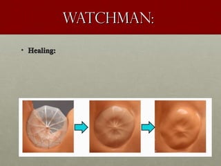 WATCHMAN:WATCHMAN:
• Healing:Healing:
 