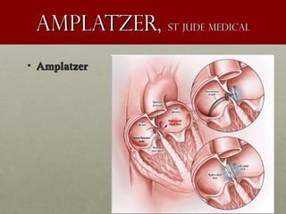 Amplatzer,Amplatzer, St jude medicalSt jude medical
• AmplatzerAmplatzer
 