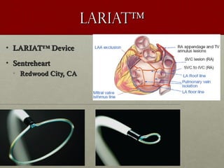 LARIAT™LARIAT™
• LARIAT™ DeviceLARIAT™ Device
• SentreheartSentreheart
• Redwood City, CARedwood City, CA
 