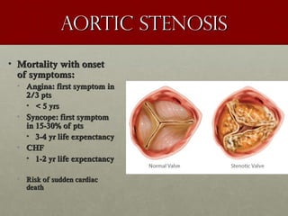 Aortic stenosisAortic stenosis
• Mortality with onsetMortality with onset
of symptoms:of symptoms:
• Angina: first symptom inAngina: first symptom in
2/3 pts2/3 pts
• < 5 yrs< 5 yrs
• Syncope: first symptomSyncope: first symptom
in 15-30% of ptsin 15-30% of pts
• 3-4 yr life expenctancy3-4 yr life expenctancy
• CHFCHF
• 1-2 yr life expenctancy1-2 yr life expenctancy
• Risk of sudden cardiacRisk of sudden cardiac
deathdeath
 