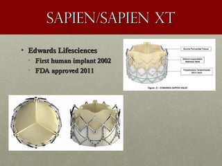 Sapien/sapien xtSapien/sapien xt
• Edwards LifesciencesEdwards Lifesciences
• First human implant 2002First human implant 2002
• FDA approved 2011FDA approved 2011
 
