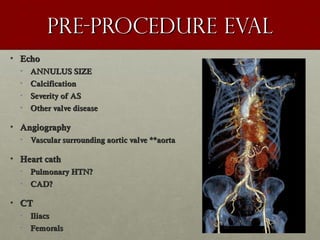 Pre-procedure evalPre-procedure eval
• EchoEcho
• ANNULUS SIZEANNULUS SIZE
• CalcificationCalcification
• Severity of ASSeverity of AS
• Other valve diseaseOther valve disease
• AngiographyAngiography
• Vascular surrounding aortic valve **aortaVascular surrounding aortic valve **aorta
• Heart cathHeart cath
• Pulmonary HTN?Pulmonary HTN?
• CAD?CAD?
• CTCT
• IliacsIliacs
• FemoralsFemorals
 