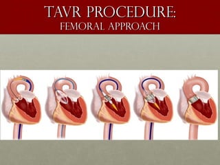 Tavr procedure:Tavr procedure:
femoral approachfemoral approach
 