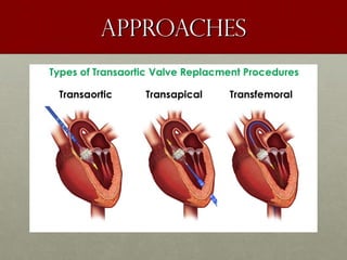 ApproachesApproaches
 