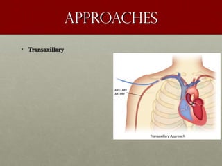 ApproachesApproaches
• TransaxillaryTransaxillary
 