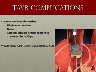 Tavr complicationsTavr complications
• Acute coronary obstructionAcute coronary obstruction
• Displaced native valveDisplaced native valve
• DeviceDevice
• Coronary ostia not far from aortic valveCoronary ostia not far from aortic valve
• even smaller in AS ptseven smaller in AS pts
** Left main: CPB, device explantation, AVR** Left main: CPB, device explantation, AVR
 
