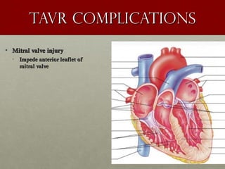 Tavr complicationsTavr complications
• Mitral valve injuryMitral valve injury
• Impede anterior leaflet ofImpede anterior leaflet of
mitral valvemitral valve
 