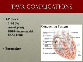 Tavr complicationsTavr complications
• AV blockAV block
• 1.8-8.5%1.8-8.5%
• AnnuloplastyAnnuloplasty
• RBBB- increases riskRBBB- increases risk
of AV blockof AV block
• PacemakerPacemaker
 