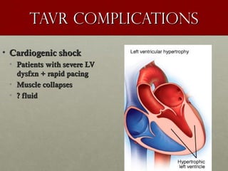 Tavr complicationsTavr complications
• Cardiogenic shockCardiogenic shock
• Patients with severe LVPatients with severe LV
dysfxn + rapid pacingdysfxn + rapid pacing
• Muscle collapsesMuscle collapses
• ? fluid? fluid
 