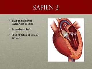 Sapien 3Sapien 3
• Base on data fromBase on data from
PARTNER II TrialPARTNER II Trial
• Paravalvular leakParavalvular leak
• Skirt of fabric at base ofSkirt of fabric at base of
devicedevice
 
