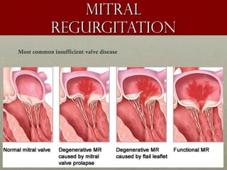 MitralMitral
regurgitationregurgitation
Most common insufficient valve disease
 