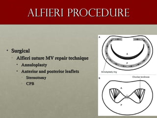 Alfieri procedureAlfieri procedure
• SurgicalSurgical
• Alfieri suture MV repair techniqueAlfieri suture MV repair technique
• AnnuloplastyAnnuloplasty
• Anterior and posterior leafletsAnterior and posterior leaflets
• SternotomySternotomy
• CPBCPB
 