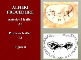 AlfieriAlfieri
procedureprocedure
Anterior 2 leafletAnterior 2 leaflet
A2A2
Posterior leafletPosterior leaflet
P2P2
Figure 8Figure 8
 