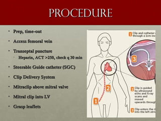 procedureprocedure
• Prep, time-outPrep, time-out
• Access femoral veinAccess femoral vein
• Transeptal punctureTranseptal puncture
• Heparin, ACT >250, check q 30 minHeparin, ACT >250, check q 30 min
• Steerable Guide catheter (SGC)Steerable Guide catheter (SGC)
• Clip Delivery SystemClip Delivery System
• Mitraclip above mitral valveMitraclip above mitral valve
• Mitral clip into LVMitral clip into LV
• Grasp leafletsGrasp leaflets
 