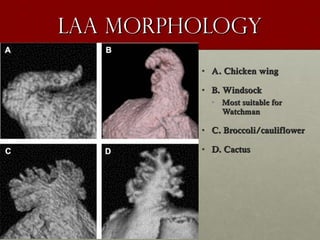 LAA MorphologyLAA Morphology
• A. Chicken wingA. Chicken wing
• B. WindsockB. Windsock
• Most suitable forMost suitable for
WatchmanWatchman
• C. Broccoli/cauliflowerC. Broccoli/cauliflower
• D. CactusD. Cactus
 