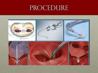 procedureprocedure
 