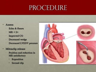 procedureprocedure
• AssessAssess
• Echo & fluoroEcho & fluoro
• MR < 2+MR < 2+
• Improved COImproved CO
• Decreased wedgeDecreased wedge
• Decreased LVEDV pressureDecreased LVEDV pressure
• Mitraclip releaseMitraclip release
• Position and reduction inPosition and reduction in
MR satisfactoryMR satisfactory
• RepositionReposition
• Second clipSecond clip
 