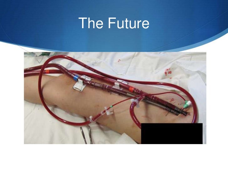 Post Cardiac Arrest Syndrome