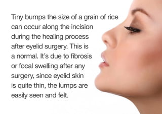 Tiny bumps the size of a grain of rice
can occur along the incision
during the healing process
after eyelid surgery. This is
a normal. It’s due to fibrosis
or focal swelling after any
surgery, since eyelid skin
is quite thin, the lumps are
easily seen and felt.
 