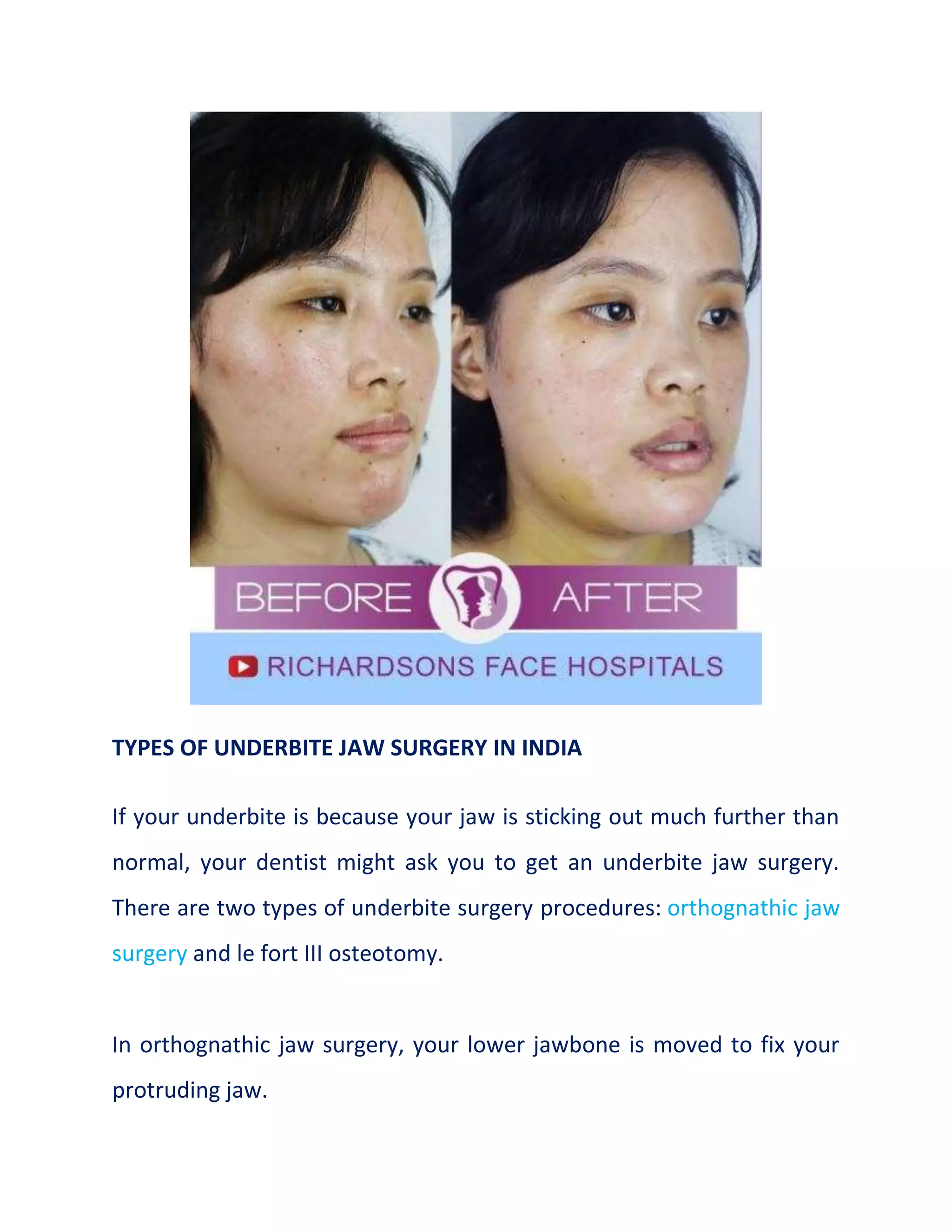 TYPES OF UNDERBITE JAW SURGERY IN INDIA
If your underbite is because your jaw is sticking out much further than
normal, your dentist might ask you to get an underbite jaw surgery.
There are two types of underbite surgery procedures: orthognathic jaw
surgery and le fort III osteotomy.
In orthognathic jaw surgery, your lower jawbone is moved to fix your
protruding jaw.
 