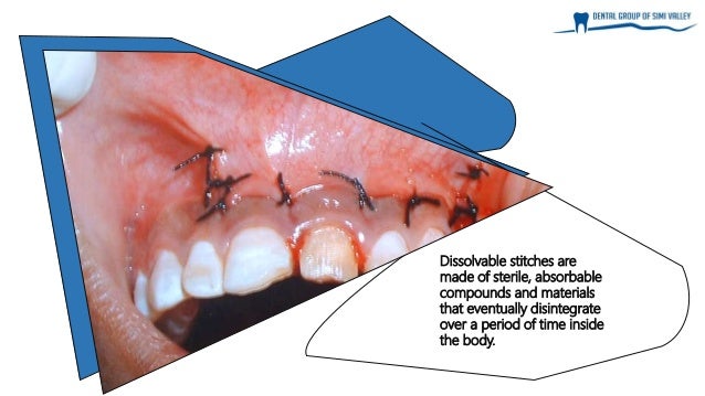 What To Know About Dissolvable Stitches After Wisdom Teeth Removal