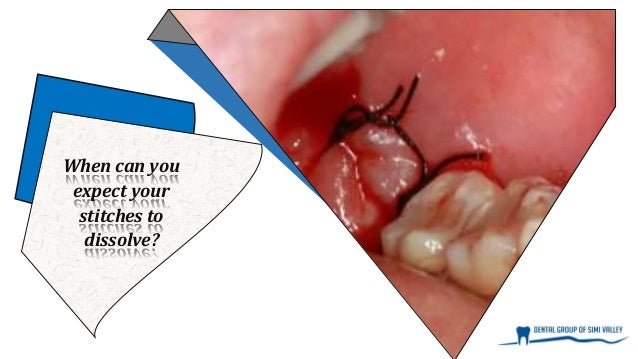 What To Know About Dissolvable Stitches After Wisdom Teeth Removal