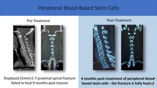 Peripheral Blood-Based Stem Cells
Displaced (5mm) C-7 proximal spinal fracture
failed to heal 9 months post trauma
Pre-Treatment Post-Treatment
4 months post-treatment of peripheral blood-
based stem cells - the fracture is fully healed
 