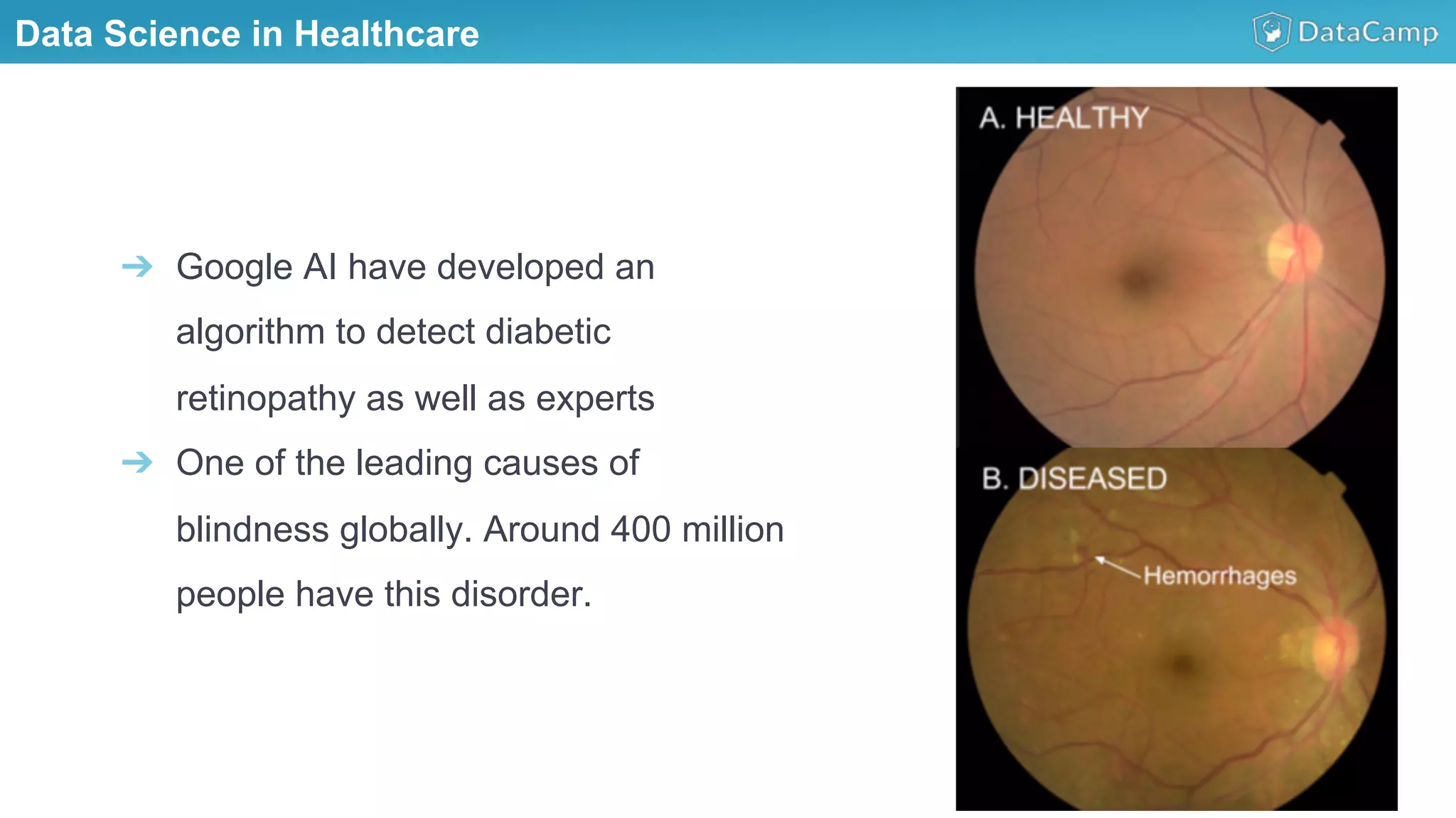 Data Science in Healthcare
➔  Google AI have developed an
algorithm to detect diabetic
retinopathy as well as experts
➔  One of the leading causes of
blindness globally. Around 400 million
people have this disorder.
 