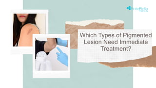 Which Types of Pigmented
Lesion Need Immediate
Treatment?
 