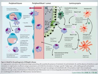 Entry to the periphery
via infected macrophages
Enhanced expression
of cytokines and
adhesion molecules
→ Leakage of the
tight junctions
and inﬁltration of
peripheral tissues
Growth
and systemic
spreading
Recruitment
of new
macrophages
Insuﬃcient antigen-
presentation and
costimulation
→ Prevention of
antigen-speciﬁc
T-cell stimulation
Migration to
lymph nodes
Tolerogenic DC
caused by presence
of interleukin 16
and interleukin 10
Newly infected macrophage
↓Intracellular killing
↓Interleukin 16
↓Interleukin 1β
↑Interleukin 10
↑Interleukin 4
↑Interleukin 6
↑Interleukin 8
↑TNF
↑Interleukin 1β
↑Interleukin 6
↑Interleukin 1β
↑Interleukin 2
↑TNFα
Absence of IFNγ
Presence of interleukin 10
→Inhibition of
DC maturation
Intestinal M2 macrophage
↓ CD11b
↓ Interleukin 12
↓ Interleukin 10
↑ CCL18
NaiveT cell
Capillary
NaiveT cell
Micro-
fold cell
(M cell) Th2 cell
Th1 cell
Accumulation of infected
macrophages and
inﬁltrating lymphocytes
→ Local inﬂammation
and focal lesions
Peripheral tissues
Endothelium
Lamina propria
Immature DC
LumenPeripheral blood
→ Vasculitis
?
?
?
Figure 5: Model for the pathogenesis ofWhipple’s disease
An inappropriate maturation of professional antigen-presenting cells caused by the presence of interleukin 10 and interleukin 16, and the absence of interferon γ and
interleukin 12 might lead to insuﬃcient antigen-presentation and inhibit the stimulation of antigen-speciﬁcT-helper type 1 cells enabling growth and systemic
spread of T whipplei.The local production of inﬂammatory cytokines through macrophages and endothelial cells in the periphery might induce lymphocyte
inﬁltration through a leaky endothelial barrier followed by focal inﬂammation even in immunologically protected tissues such as joints or the brain. CCL=chemokine
(C-C motif) ligand. DC=dendritic cell.TNFα=tumour necrosis factor α.
Lancet Infect Dis 2008; 8: 179–90
 
