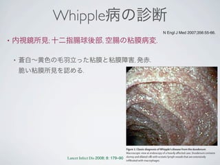 Whipple病の診断
• 内視鏡所見; 十二指腸球後部, 空腸の粘膜病変.
• 蒼白∼黄色の毛羽立った粘膜と粘膜障害, 発赤.
脆い粘膜所見を認める.
N Engl J Med 2007;356:55-66.
Review
Figure 1: Classic diagnosis ofWhipple’s disease from the duodenum
Macroscopic view at endoscopy of a heavily aﬀected case. Duodenum contains
clumsy and dilated villi with ecstatic lymph vessels that are extensively
inﬁltrated with macrophages.
Lancet Infect Dis 2008; 8: 179–90
 