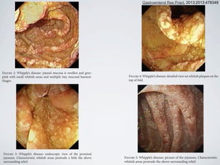 Figure 2: Whipple’s disease: jejunal mucosa is swollen and grey-
pink with small whitish areas and multiple tiny mucosal haemor-
rhages.
Figure 3: Whipple’s disease: endoscopic view of the proximal
Figure 5: Whipple’s disease: picture of the jejunum. Characteristic
whitish areas protrude the above surrounding relief.
Figure 6: Whipple’s disease: endoscopic view of the proximal
jejunum. Transverse folds are low, reduced, and swollen.
Figure 2: Whipple’s disease: jejunal mucosa is swollen and grey-
pink with small whitish areas and multiple tiny mucosal haemor-
rhages.
Figure 3: Whipple’s disease: endoscopic view of the proximal
jejunum. Characteristic whitish areas protrude a little the above
surrounding relief.
Figure 5: Whipple’s disease: picture of the jejunum. Characteristic
whitish areas protrude the above surrounding relief.
Figure 6: Whipple’s disease: endoscopic view of the proximal
jejunum. Transverse folds are low, reduced, and swollen.
Figure 4: Whipple’s disease: detailed view on whitish plaques on the
top of fold.
4 Gastroenterology Research and Practice
Figure 2: Whipple’s disease: jejunal mucosa is swollen and grey-
pink with small whitish areas and multiple tiny mucosal haemor-
Figure 5: Whipple’s disease: picture of the jejunum. Characteristic
whitish areas protrude the above surrounding relief.
Gastroenterol Res Pract. 2013;2013:478349
 