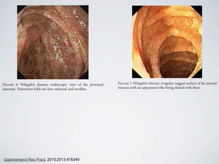 Figure 6: Whipple’s disease: endoscopic view of the proximal
jejunum. Transverse folds are low, reduced, and swollen.
Figure 4: Whipple’s disease: detailed view on whitish plaques on the
top of fold.
Figure 7: Whipple’s disease: irregular rugged surface of the jejunal
mucosa with an appearance like being dusted with flour.
Gastroenterol Res Pract. 2013;2013:478349
 