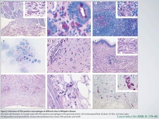 A B C
D E F
G H I
Figure 3: Detection of PAS-positive macrophages at diﬀerent sites inWhipple’s disease
(A) Colon. (B) Stomach. (C) Lymph node with PAS-positive macrophages in the germinal centres. (D) Cerebrospinal ﬂuid. (E) Brain. (F) Skin. (G) Heart valve.
(H) Myocardium and epicardial fat. (I) Synovial membrane from a knee. PAS=periodic acid-Schiﬀ. Lancet Infect Dis 2008; 8: 179–90
 