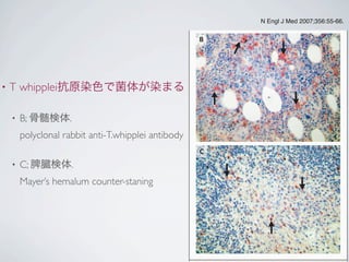 • T whipplei抗原染色で菌体が染まる
• B; 骨髄検体.
polyclonal rabbit anti-T.whipplei antibody 
• C; 脾臓検体.
Mayer’s hemalum counter-staning
B
C
N Engl J Med 2007;356:55-66.
 