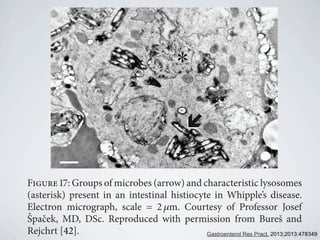 Figure 17: Groups of microbes (arrow) and characteristic lysosomes
(asterisk) present in an intestinal histiocyte in Whipple’s disease.
Electron micrograph, scale = 2 𝜇m. Courtesy of Professor Josef
ˇSpaˇcek, MD, DSc. Reproduced with permission from Bureˇs and
Rejchrt [42]. Gastroenterol Res Pract. 2013;2013:478349
 