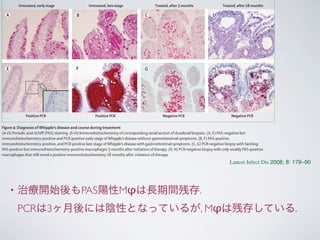 • 治療開始後もPAS陽性Mφは長期間残存.
PCRは3ヶ月後には陰性となっているが, Mφは残存している.
http://infection.thelancet.com Vol 8 March 2008
Untreated, early stage Untreated, late stage Treated, after 3 months Treated, after 18 months
Positive PCR Positive PCR Negative PCR Negative PCR
A
E
B
F
C
G
D
H
Figure 4: Diagnosis ofWhipple’s disease and course during treatment
(A–D) Periodic acid-Schiﬀ (PAS) staining. (E–H) Immunohistochemistry of corresponding serial section of duodenal biopsies. (A, E) PAS-negative but
immunohistochemistry-positive and PCR-positive early stage ofWhipple’s disease without gastrointestinal symptoms. (B, F) PAS-positive,
immunohistochemistry-positive, and PCR-positive late stage ofWhipple’s disease with gastrointestinal symptoms. (C, G) PCR-negative biopsy with fainting
PAS-positive but immunohistochemistry-positive macrophages 3 months after initiation of therapy. (D, H) PCR-negative biopsy with only weakly PAS-positive
macrophages that still reveal a positive immunohistochemistry 18 months after initiation of therapy.
Lancet Infect Dis 2008; 8: 179–90
 