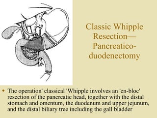 The operation' classical 'Whipple involves an 'en-bloc' resection of the pancreatic head, together with the distal stomach and omentum, the duodenum and upper jejunum, and the distal biliary tree including the gall bladder Classic Whipple Resection— Pancreatico-duodenectomy 